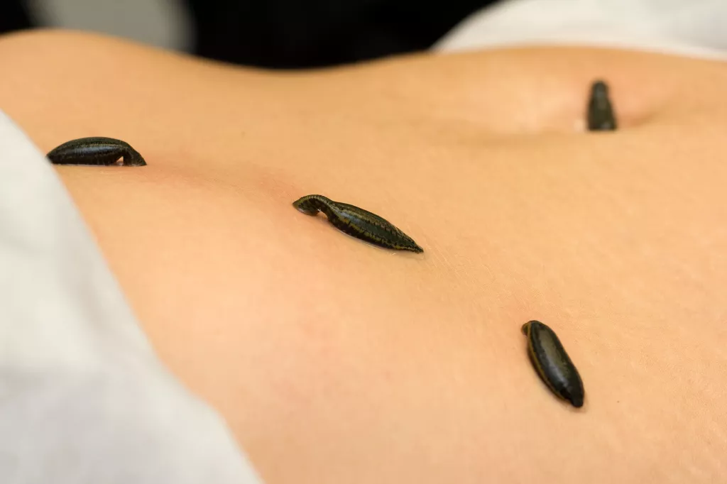 Blutegeltherapie Blutegeltherapie